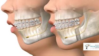 Part2 Orthognathic surgery lec9 5th Stage [upl. by Aisereht]