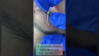 Milia Removal In Gurgaon For an appointmentCall on 8875865077 or visitwwwdranweshapoddarcom [upl. by Tenenbaum262]