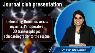 Journal Club Thrombus or Myxoma 3D Transesophageal Echocardiography to the rescue [upl. by Al274]