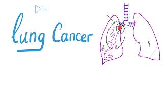 Lung Cancer  Bronchogenic Carcinoma  The most COMPREHENSIVE Explanation [upl. by Vaientina]