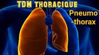 SCANNER THORACIQUE Pneumothorax avec collapsus passif [upl. by Yorgos]