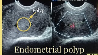 Ultrasound Report of endometrial polyp Sonography of Endometrial masspolyp [upl. by Atsirc]