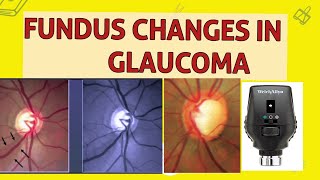 OPTIC DISC CHANGES IN GLAUCOMA [upl. by Leventhal]