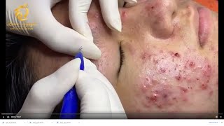 Treatment of acne tablets pustules and blackheads 359  Loan Nguyen [upl. by Assek806]