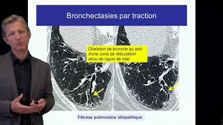 Fibrose pulmonaire Cottin Cours DES 2017 criteres diagnostiques FPI [upl. by Pylle801]