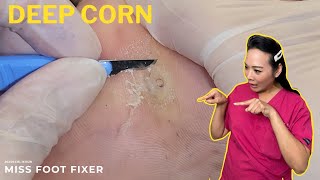 DEEP CORN REMOVAL😍 [upl. by Gershom771]