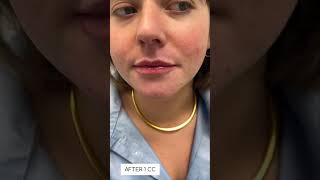 Lip fillers over time Skin Tightening Botox and Lip Fillers by Skinsation LA [upl. by Fi121]