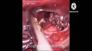 Thoracoscopic repair of Esophageal atresia with tracheoesophageal fistula [upl. by Lahcear]