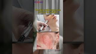 3 Disadvantages of Microdermabrasion You Must Know microdermabrasion mychway hydrafacial fyp [upl. by Carlen189]