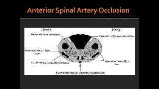 Complete Occlusion of Anterior Spinal Artery [upl. by Alena]