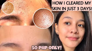 HOW TO GET RID OF TINY BUMPS ON FOREHEADFACE FAST  FUNGAL ACNE how i cleared my skin ENG SUB [upl. by Yendroc]