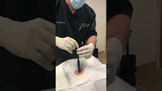 Bone Marrow Aspiration Technique with Marrow Cellution [upl. by Eyanaj]