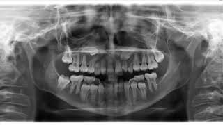 Impacted canines and congenitally missing wisdom teeth and 18 on panoramic radiograph [upl. by Warford]