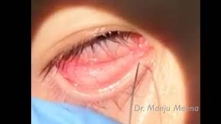 Lacrimal Syringing [upl. by Haroved]