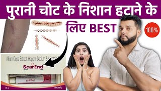 पुरानी चोट के निशान हटाने की क्रीम  Scarend Gel Review In Hindi [upl. by Annaehs]