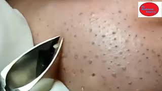 How To Removal Blackheads And How To Get Rid of Blackhead 27 [upl. by Acirat368]