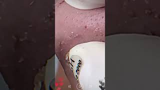 Skincare  Blackheads Removal 167 skincare skincare blackheads blackheads [upl. by Gilud]