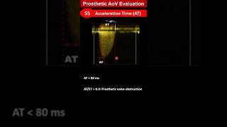 Prosthetic Aortic Valve Evaluation [upl. by Goerke]