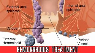 Hemorrhoidsdifferent types of hemorrhoids internal and external Hemorrhoids Hemorrhoids treatment [upl. by Teeniv]