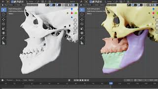 Virtual planning for orthognathic surgery [upl. by Taite]