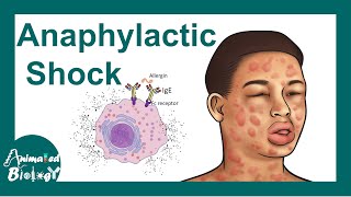 Anaphylactic shock  Anaphylactic Reaction Symptoms and Treatment [upl. by Nnylrefinnej18]