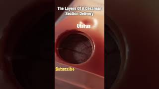 Beautiful Breech C Section Delivery 40 weeks 10day pregnancy 🤱shots [upl. by Cod111]