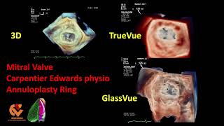 Mitral Valve Carpentier Edwards Physio Annuloplasty Ring [upl. by Enymzaj151]