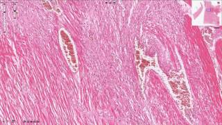 Myocardial Infarction  Histopathology [upl. by Jolee]