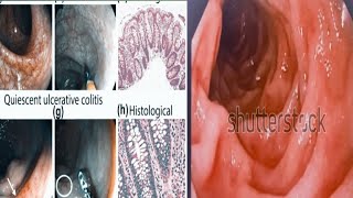 lip hemangioma viralvideo shortsyoutube shortsyoutube viralvideo reelsfb [upl. by Danelle332]