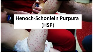 HenochSchonlein Purpura HSP [upl. by Naashom146]