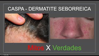 CASPA  DERMATITE SEBORREICA Mitos e Verdades  Com Luiz Gameiro dermatologista [upl. by Nosnevets]