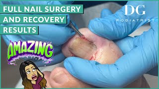 Full Nail Surgery and Recovery Results  The Foot Scraper DG Podiatrist [upl. by Ottie447]