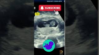 Fetal ultrasound of 10 weeks 6 days  Mother thinks its baby boy moving pregnancy ultrasound yt [upl. by Attenoj]