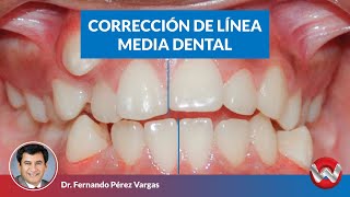 Corrección de linea media dental [upl. by Ovatsug]