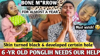 6 Yr Old Little Girl Ponglih needs your help Must Watch [upl. by Lidda]