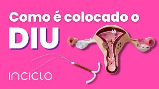 Como é Colocado o Diu  Como Funciona a Colocação do Diu [upl. by Nefen]