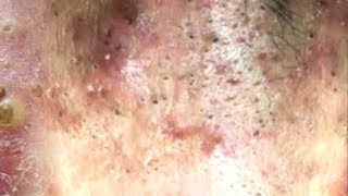 Cheeks Blackheads On The Face Easy  How To Remove Blackheads Easy [upl. by Austine530]