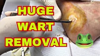 Large Wart Removal from Foot [upl. by Demona]