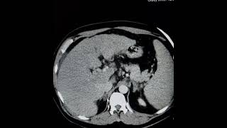 HCC with tumor thrombus extending into LHVIVCLT atrium intrahepatic branches of PV and PV itself [upl. by Kevon877]