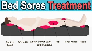 Pressure Ulcers Decubitus Ulcers Bedsores Treatment [upl. by Feledy577]