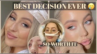 NOSE JOB VLOG My entire Rhinoplasty recovery  results the BEST Sydney surgeon [upl. by Anne-Marie]