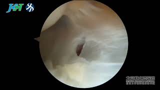 Arthroscopic Repair of Extensor Carpi Radialis Brevis in Patients With Tennis Elbow [upl. by Elamor]