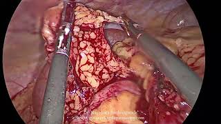 Ovarian Tumor [upl. by Ellenaj]