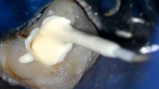 Root Canal Sealer Placement Using Endo Activator [upl. by Treborsemaj]