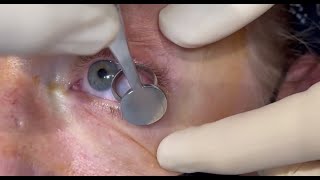 Chalazion Incision and Drainage Procedure [upl. by Aenitsirhc]