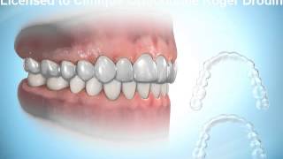 Invisalign Roger Drouin orthodontiste certifié [upl. by Atihana]