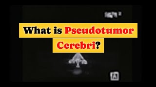 What is Pseudotumor Cerebri [upl. by Oinafipe]