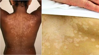 What is Tinea Versicolor Causes Treatment [upl. by Treblah]