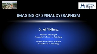 Spinal Dysraphism [upl. by Heisel]