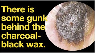 There is some gunk behind the charcoalblack waxear wax removal  ear cleaning  ASMR  relaxation [upl. by Grimbal]